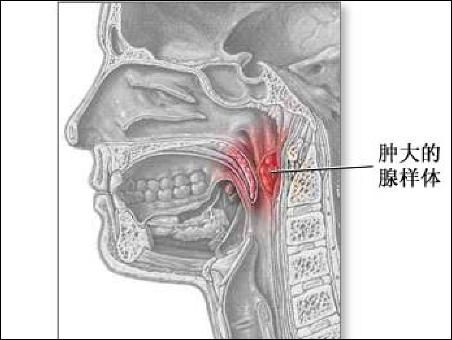 鼻咽部腺样体图片